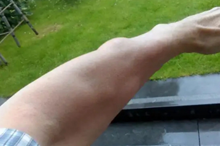 皮肤猪囊尾蚴病胳膊症状图 皮肤猪囊尾蚴病胳膊症状图