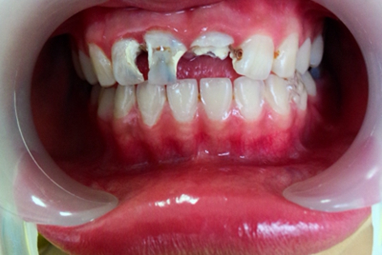 急性浆液性根尖周炎牙龈红肿图