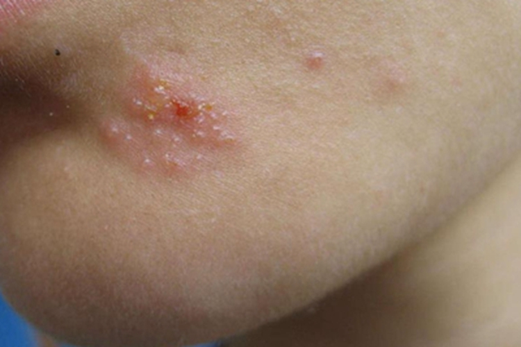 单纯疱疹下巴有一堆小水疱图