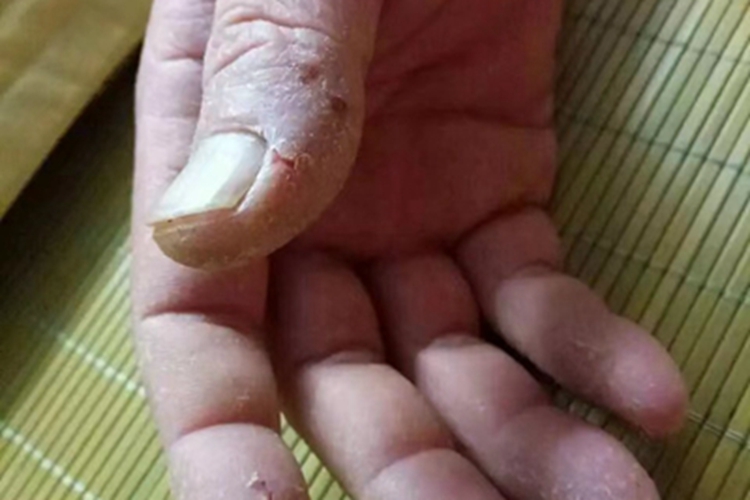 手部湿疹手部皮肤裂开图