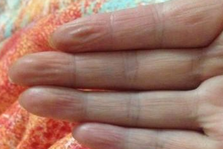 营养不良手指头干瘪有竖纹图