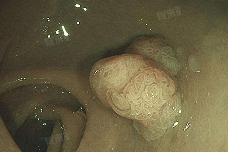 结肠管状腺瘤伴低级别上皮内瘤变