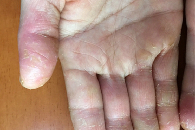 进行性指掌角皮症手指脱皮图