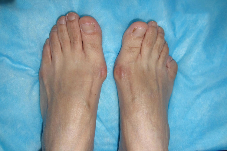 轻微拇外翻图 轻微拇外翻图