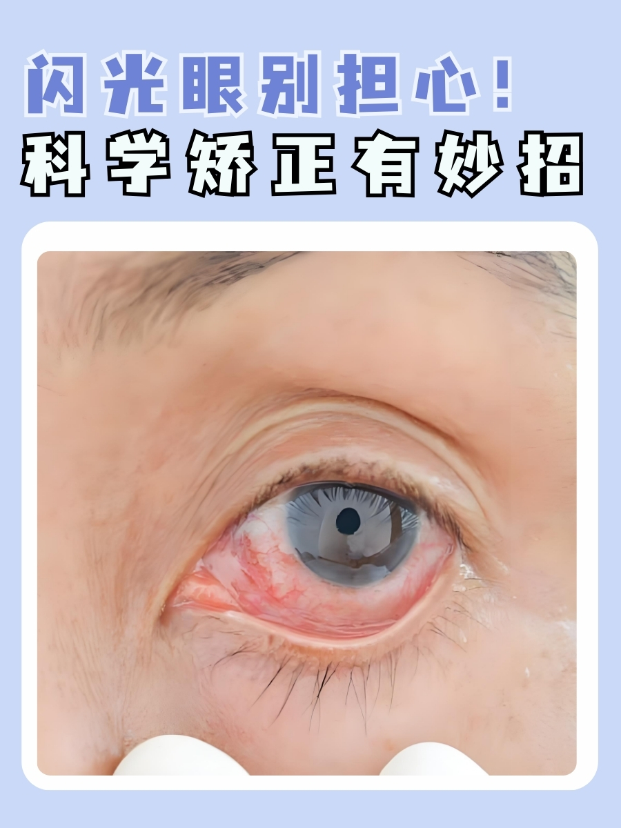 闪光眼别担心!科学矫正有妙招