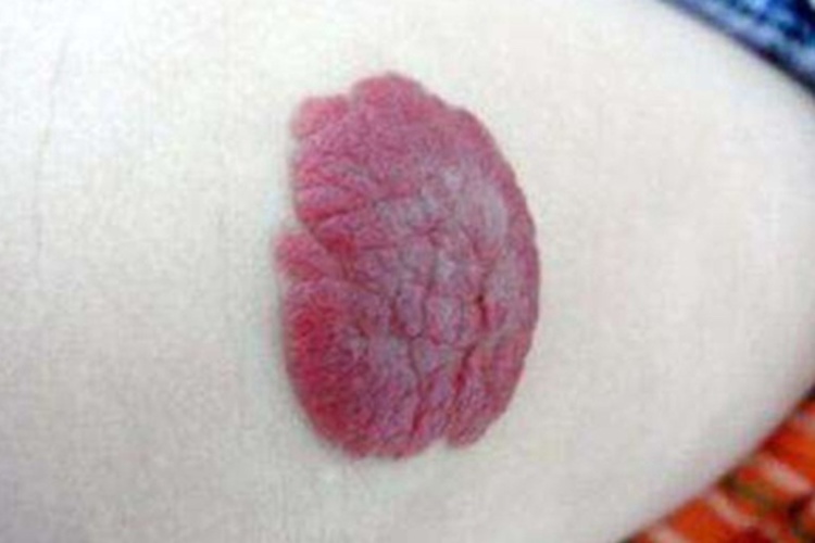 蔓状血管瘤图 蔓状血管瘤图