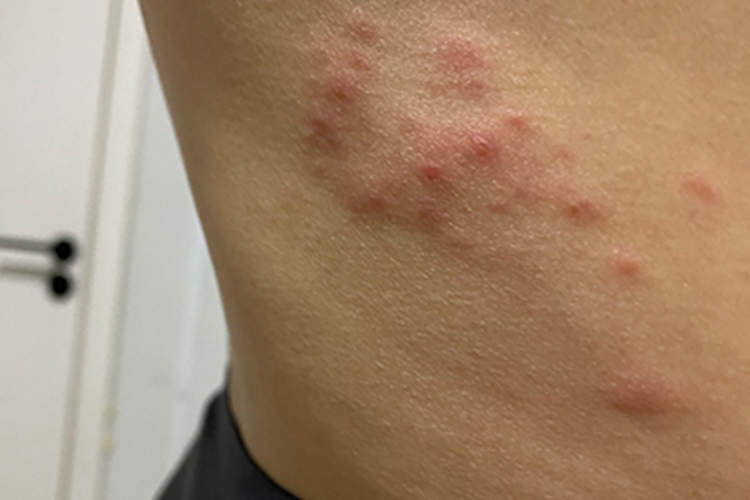 丘疹性荨麻疹腹部症状图 丘疹性荨麻疹腹部症状图