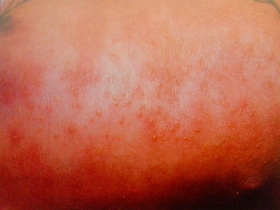 新生儿毒性红斑胸前发红伴有小丘疹图.jpg