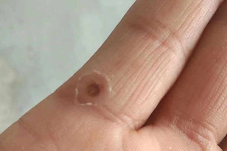 寻常疣手指结痂图
