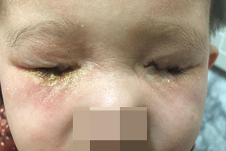 儿童期特应性皮炎眼部黄痂图