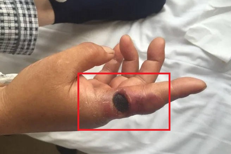 炭疽病手指大坑图