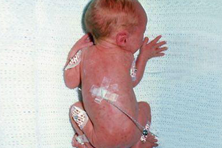 先天性风疹图 先天性风疹图