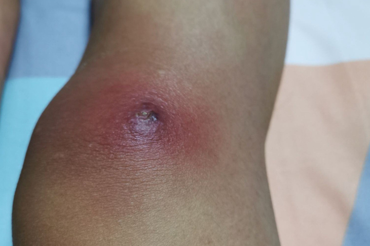 腿上长痈图 腿上长痈图