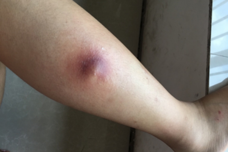皮脂腺囊肿小腿疙瘩图
