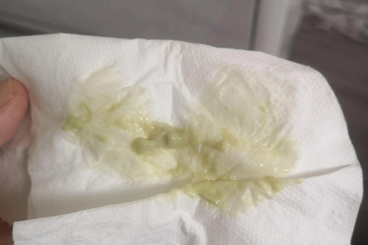 孕26周分泌物增多发黄图 孕26周分泌物增多发黄图