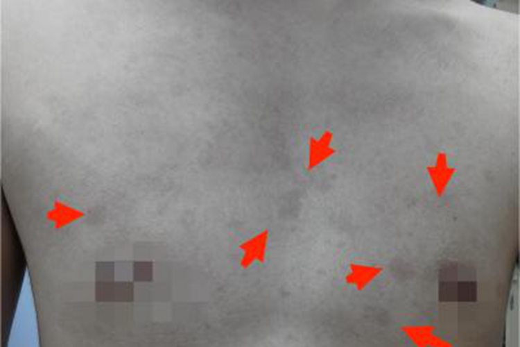 体癣胸部一片褐色斑图