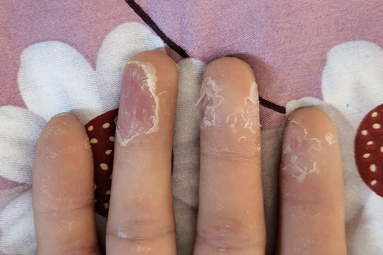 手部剥脱性角质松解症图