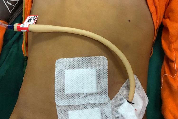 经腹穿刺盆腔引流管位置图 经腹穿刺盆腔引流管位置图