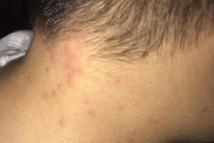 夏季皮炎后颈症状图