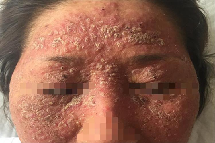 亚急性湿疹面部斑图