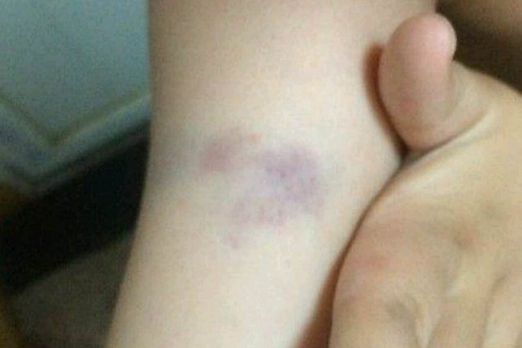 儿童白血病腿上有瘀斑图 儿童白血病腿上有瘀斑图