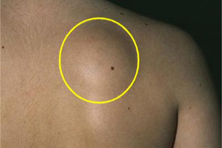 皮下脂肪瘤背部症状图