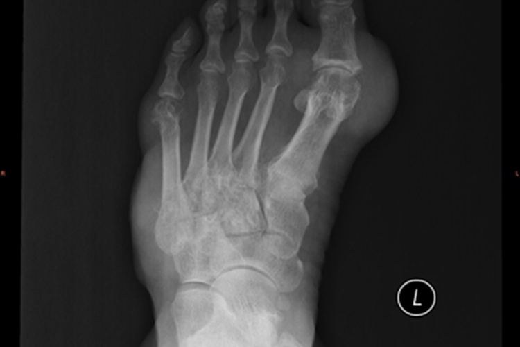 痛风左脚多处变形图