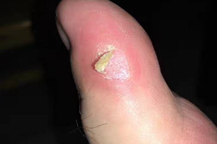 寻常疣脚趾症状图 寻常疣脚趾症状图