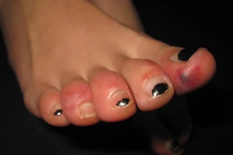 寒冷性多形红斑红肿图 寒冷性多形红斑红肿图