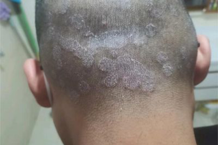 成人脂溢性皮炎头皮脱屑图