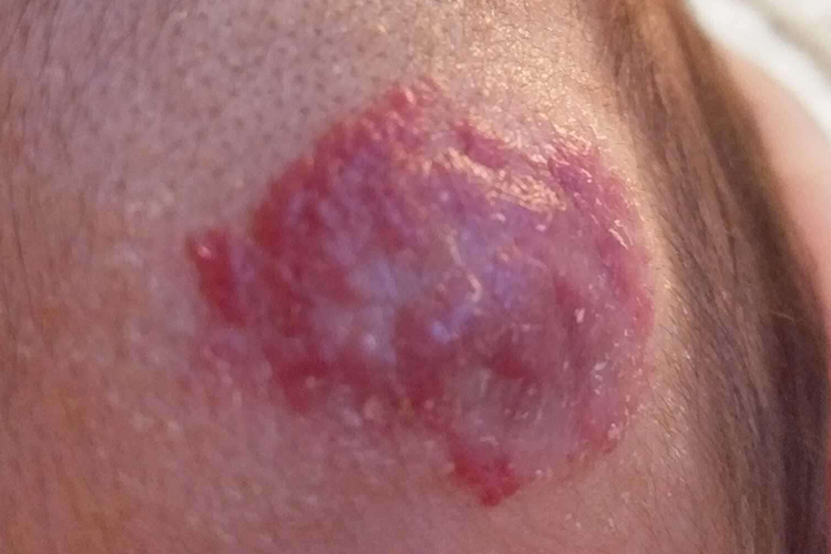 后脑勺海绵状血管瘤图