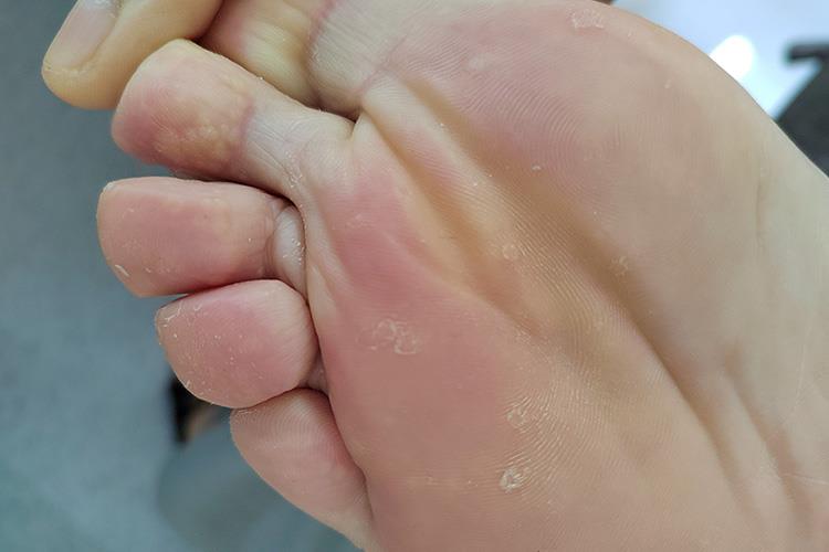 脚心汗疱疹脱屑图