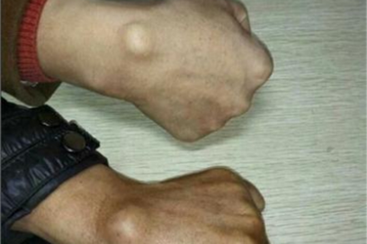 单发性骨软骨瘤手腕症状图