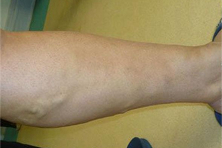 下肢静脉曲张小腿包块图