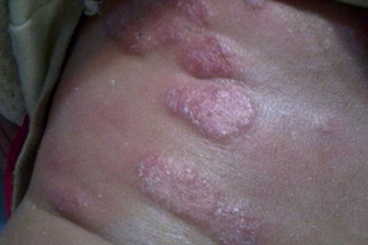 干燥型婴儿湿疹背部脱屑图