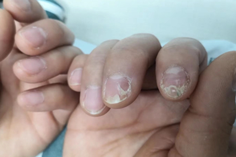 手足口病指甲上有小块皮图