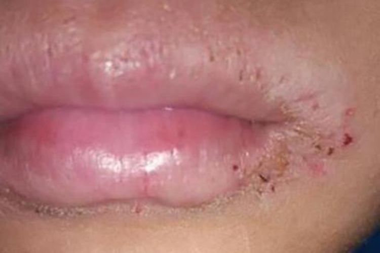 口腔白色念珠菌性口角炎图 口腔白色念珠菌性口角炎图