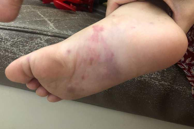 过敏性紫癜导致脚底板呈紫色淤血图