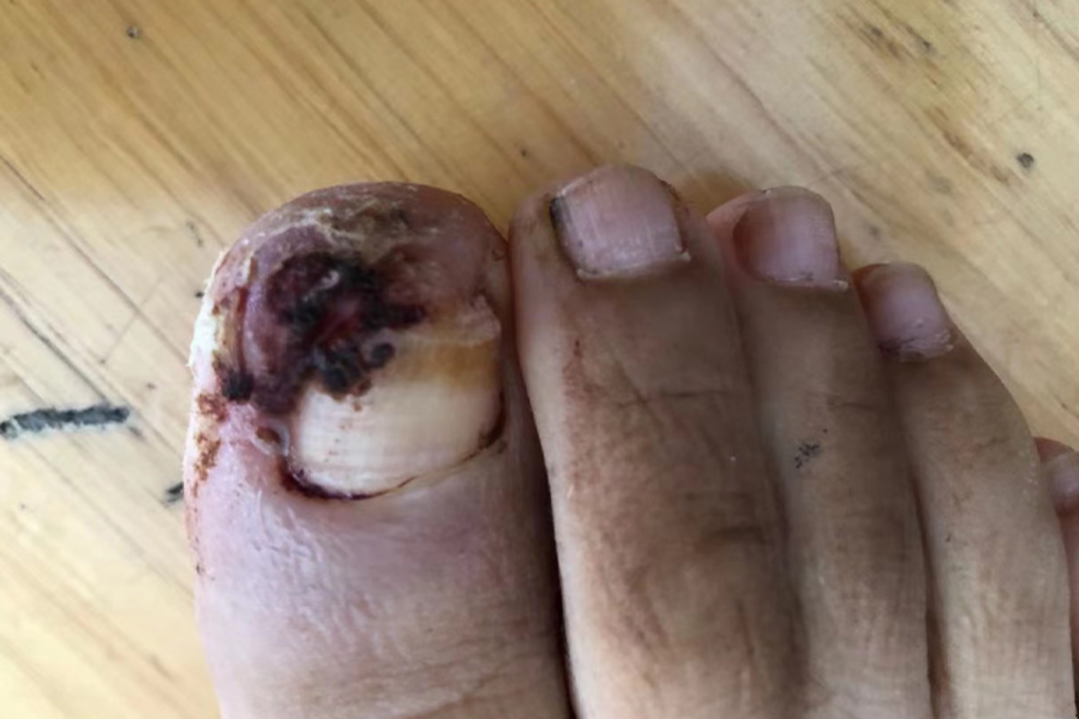 甲黑素瘤局部指甲图