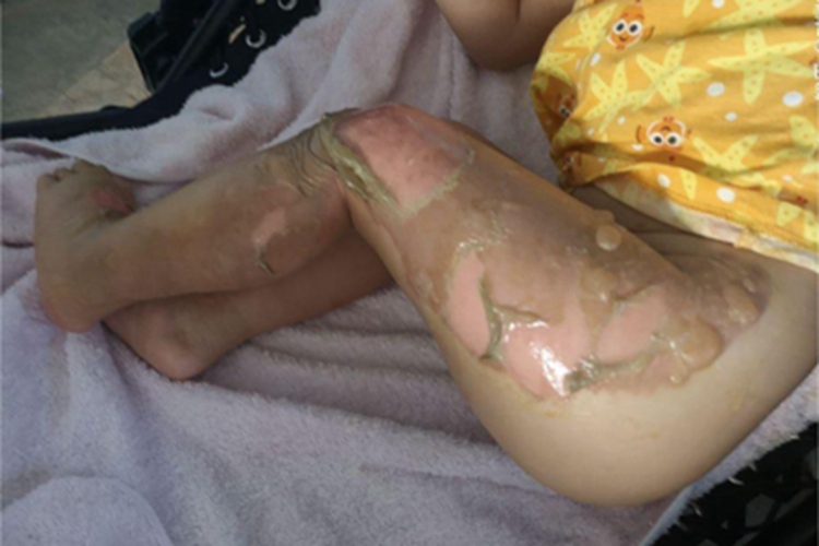 浅二度烫伤腿水疱图 浅二度烫伤腿水疱图