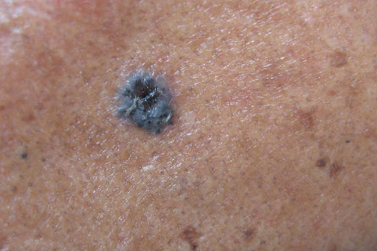 色素型基底细胞癌图