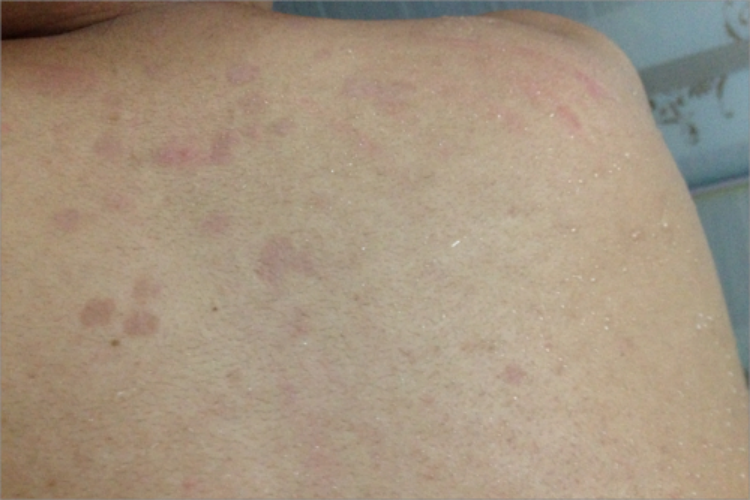 孩子背部紫癜紫色条纹图