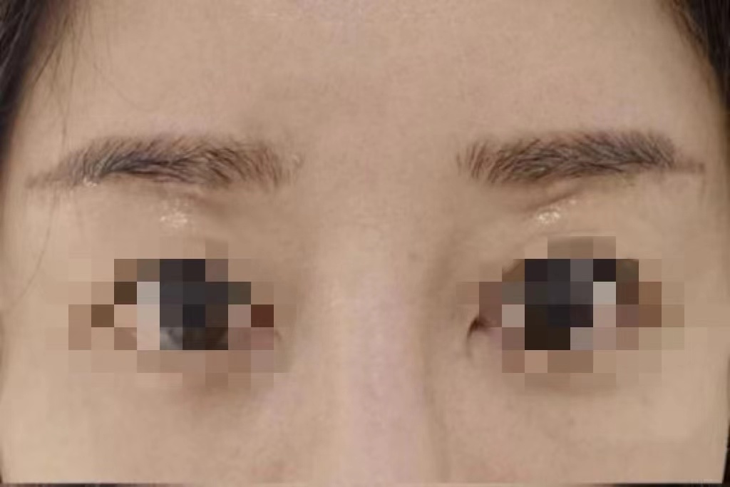 提眉术后瘢痕图 提眉术后瘢痕图