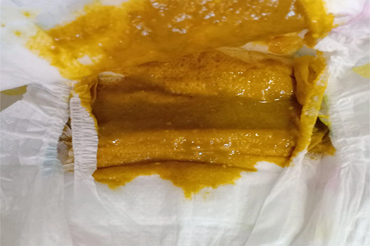 喝蜂蜜水过敏的腹泻症状图