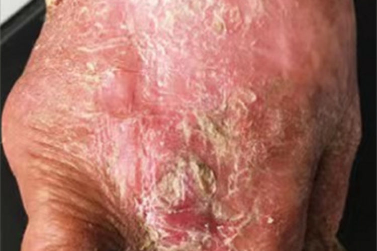 着色芽生菌病手背症状图 着色芽生菌病手背症状图