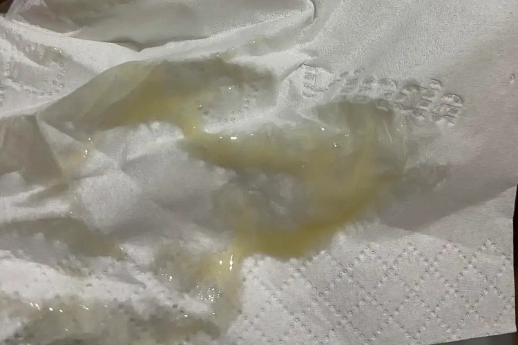 黄绿色泡沫状分泌物图 黄绿色泡沫状分泌物图