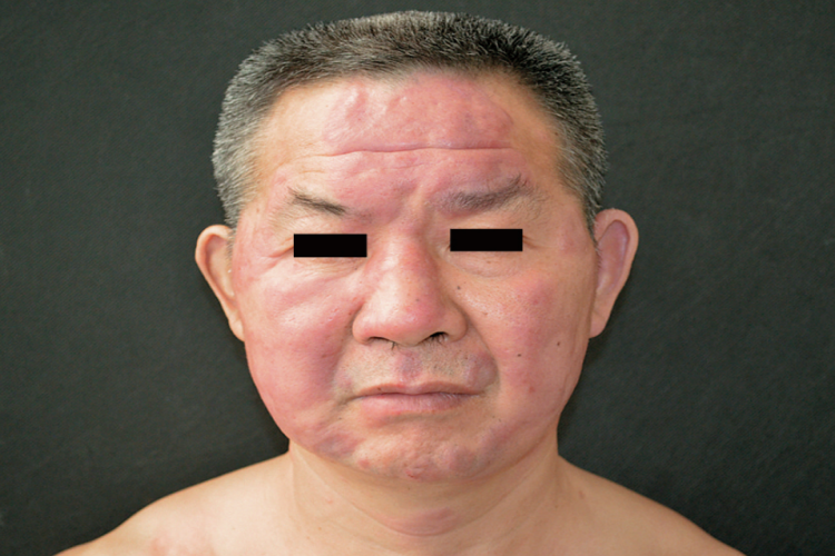 瘤型麻风额头丘疹图