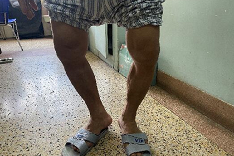 肥大性骨关节病膝盖症状图