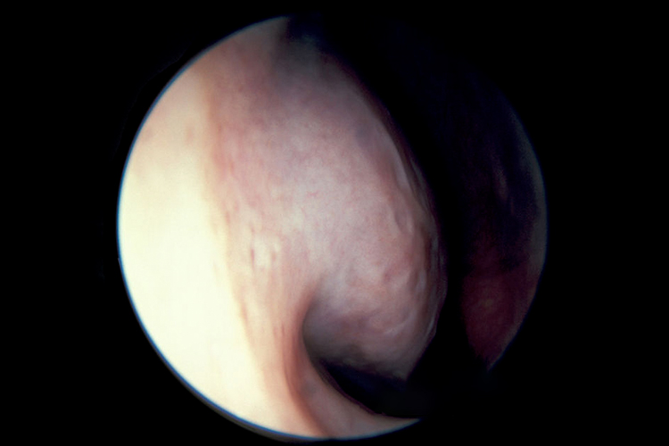 变应性鼻炎图 变应性鼻炎图