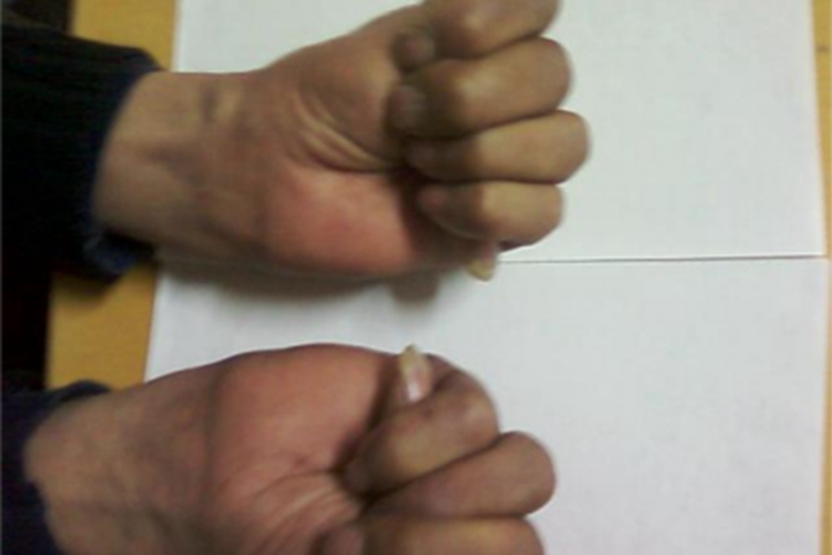 马方综合征手指细长图